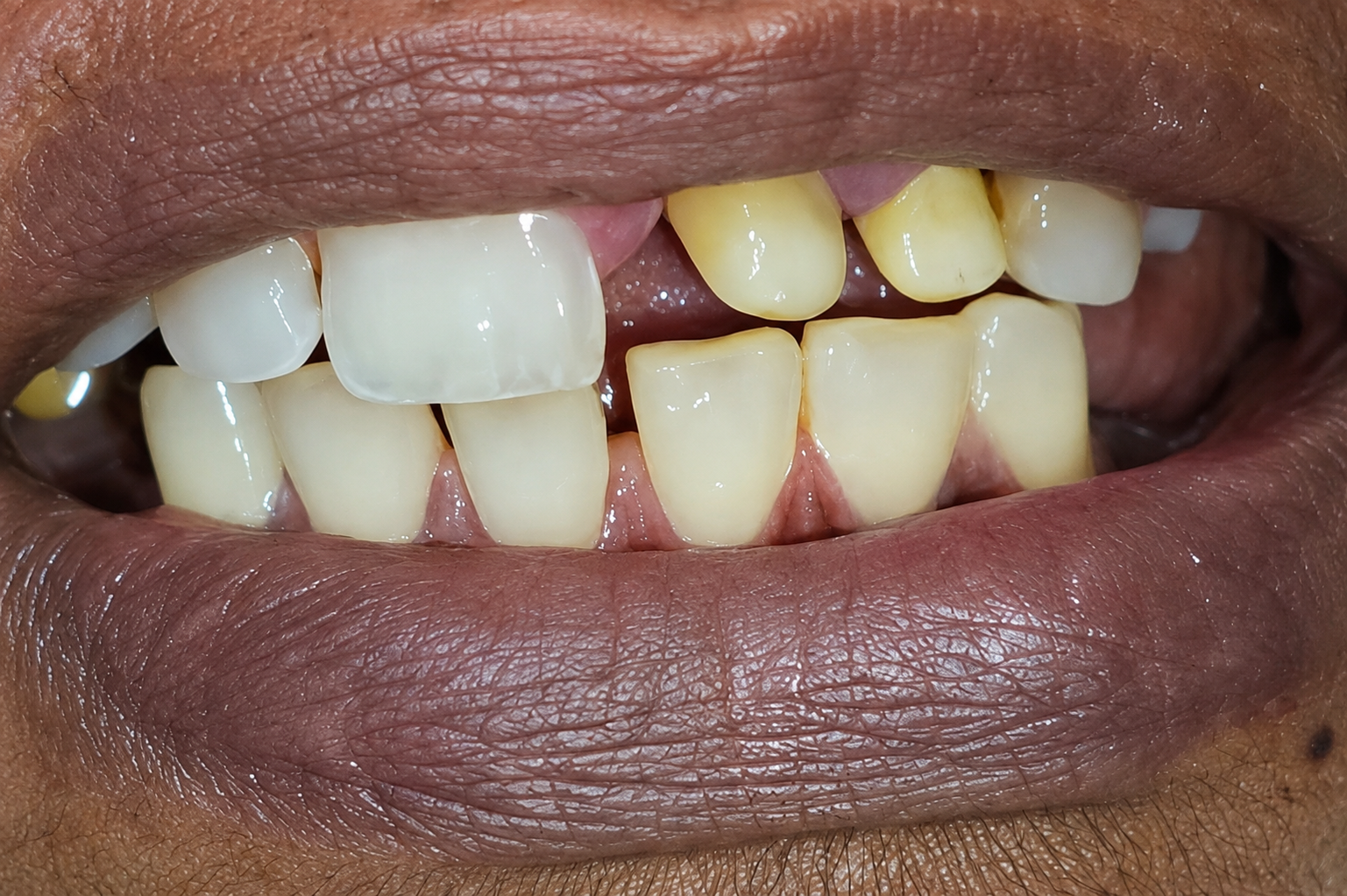 before treatment