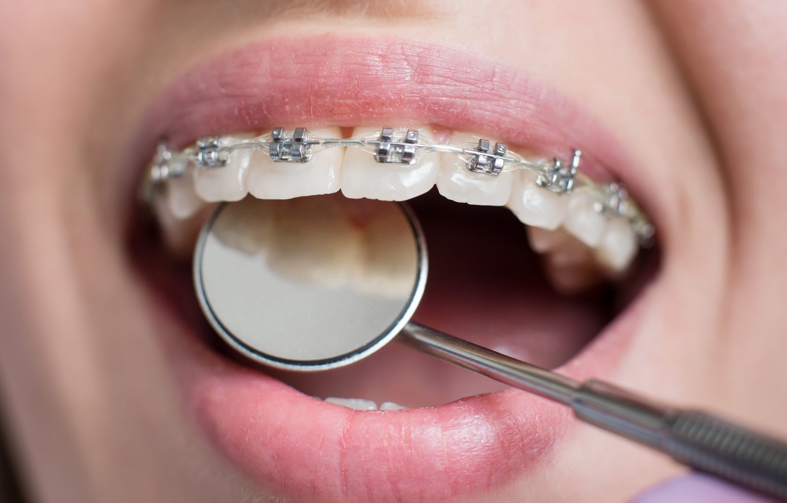 dental braces