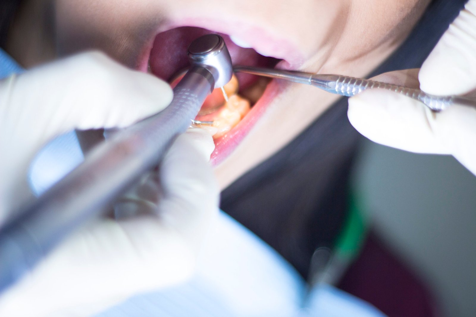 Root canal treatment