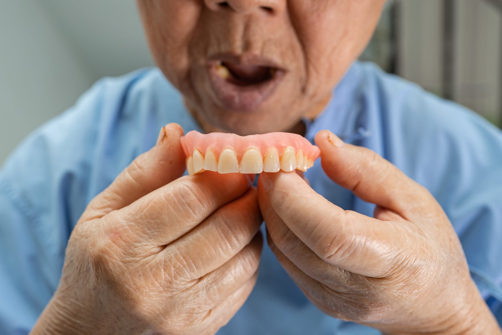 Implant-Supported Complete Dentures